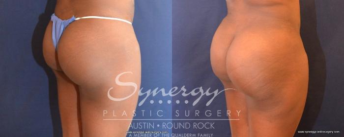 Before & After Buttock Augmentation/Brazilian Butt Lift Case 497 View #3 View in Austin, TX