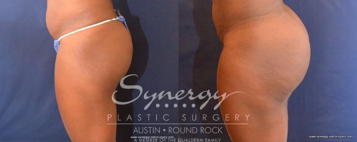 Before & After Buttock Augmentation/Brazilian Butt Lift Case 497 View #4 View in Austin, TX