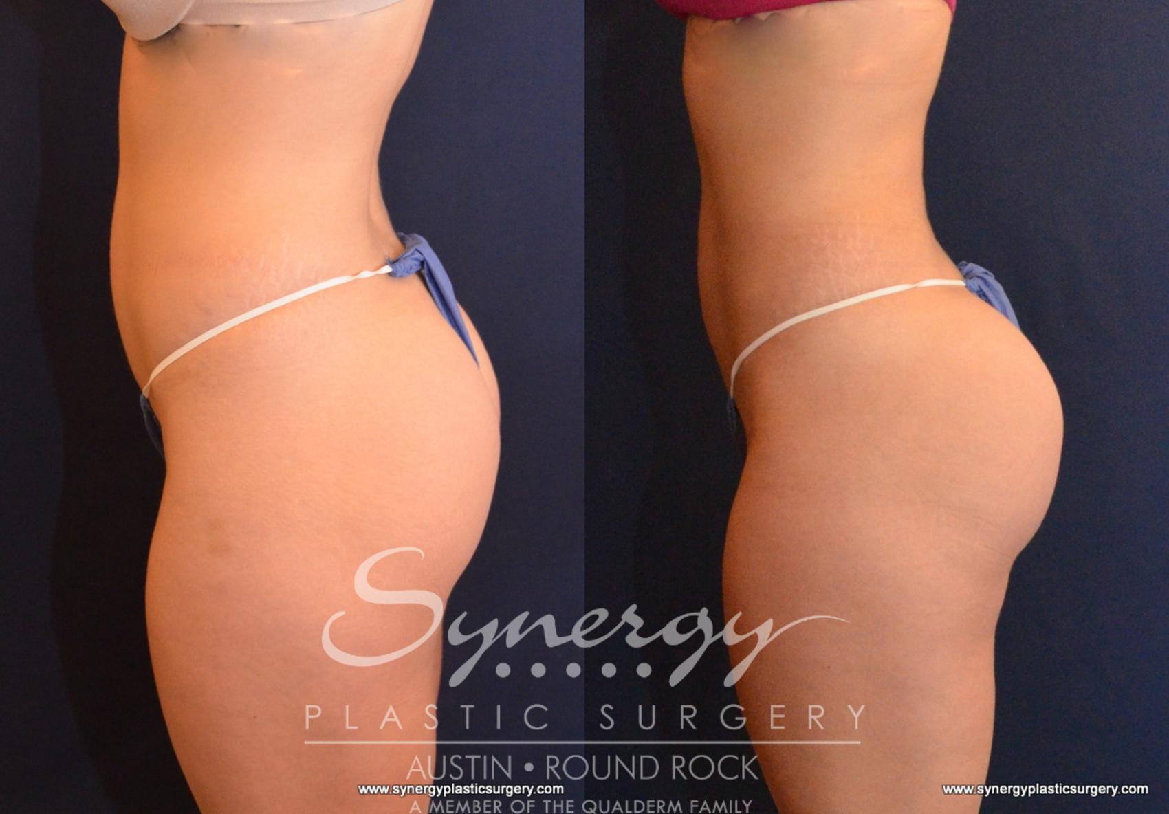 Brazilian Butt Lift Before and After Pictures Case 596, Houston, TX