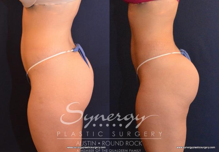 Buttock Augmentation/Brazilian Butt Lift Before and After Pictures Case 593, Austin, TX