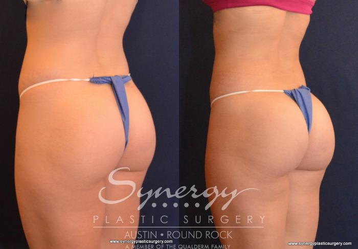 Before & After Buttock Augmentation/Brazilian Butt Lift Case 593 View #2 View in Austin, TX