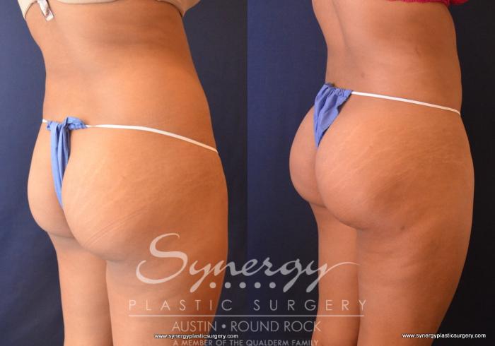 Before & After Buttock Augmentation/Brazilian Butt Lift Case 716 View #3 View in Austin, TX