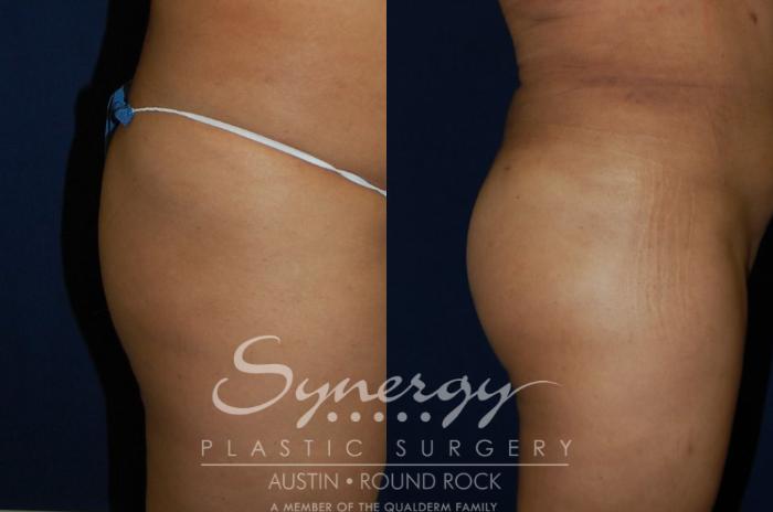Before & After Buttock Augmentation/Brazilian Butt Lift Case 90 View #1 View in Austin, TX