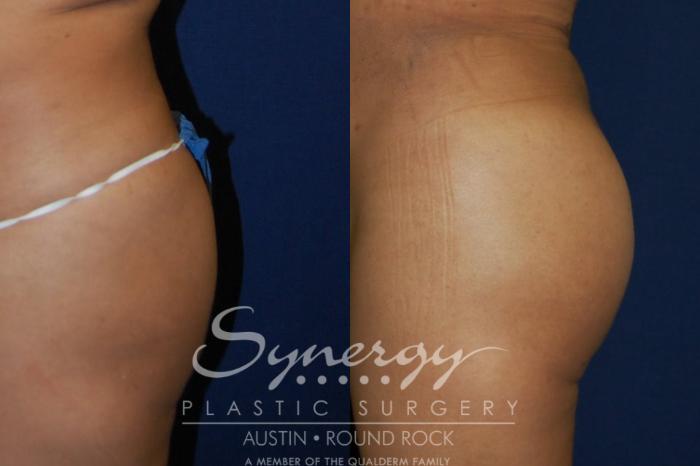 Before & After Buttock Augmentation/Brazilian Butt Lift Case 90 View #2 View in Austin, TX