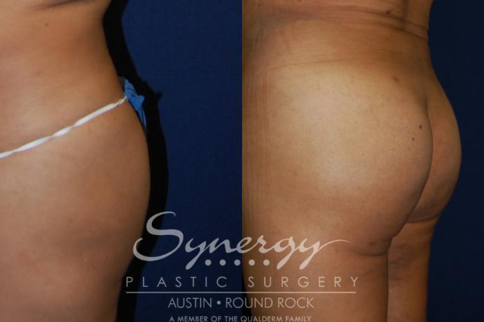 Before & After Buttock Augmentation/Brazilian Butt Lift Case 90 View #3 View in Austin, TX