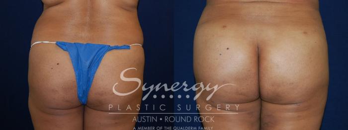Before & After Buttock Augmentation/Brazilian Butt Lift Case 90 View #4 View in Austin, TX