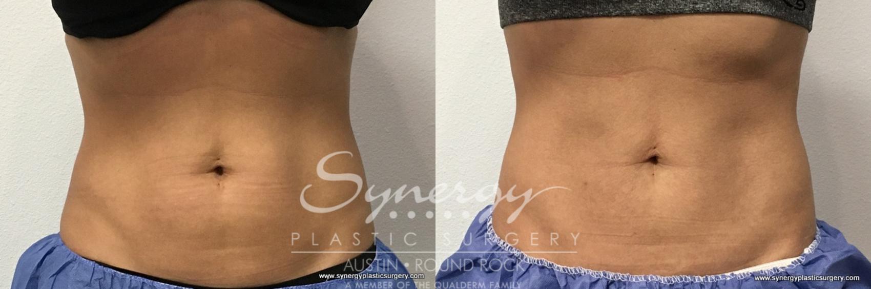 Before & After CoolSculpting® Case 762 View #1 View in Round Rock, TX