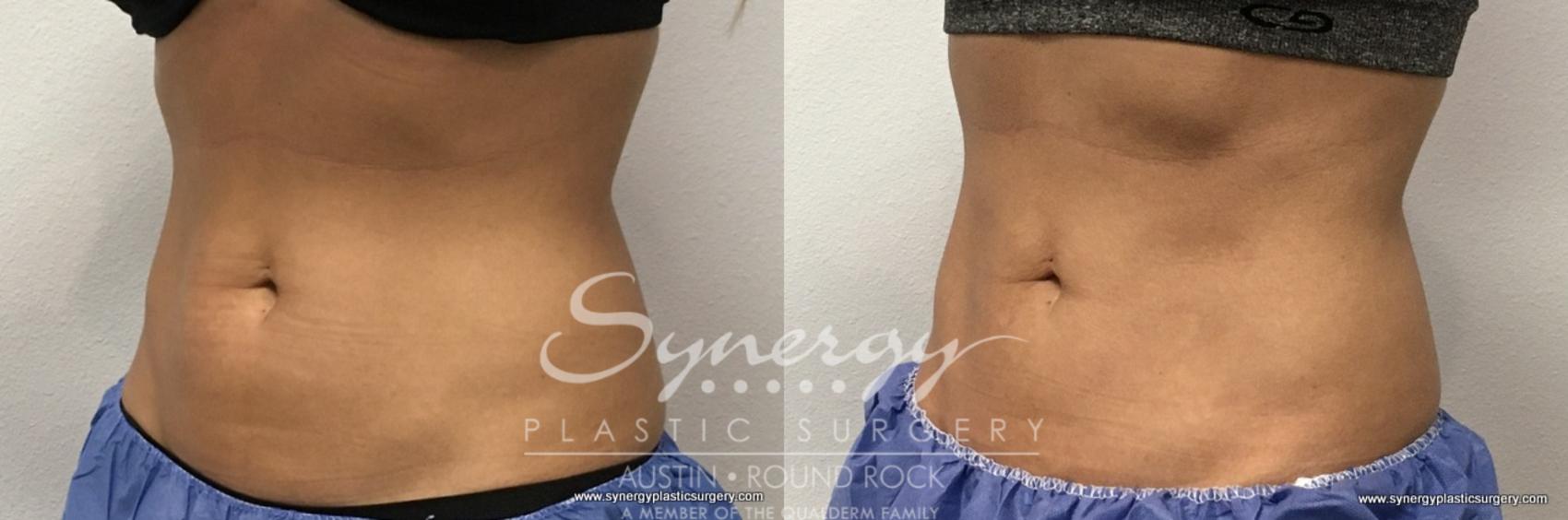 Before & After CoolSculpting® Case 762 View #2 View in Round Rock, TX
