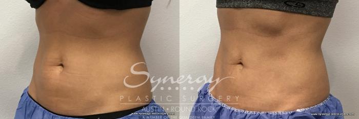 Before & After CoolSculpting® Case 762 View #2 View in Austin, TX