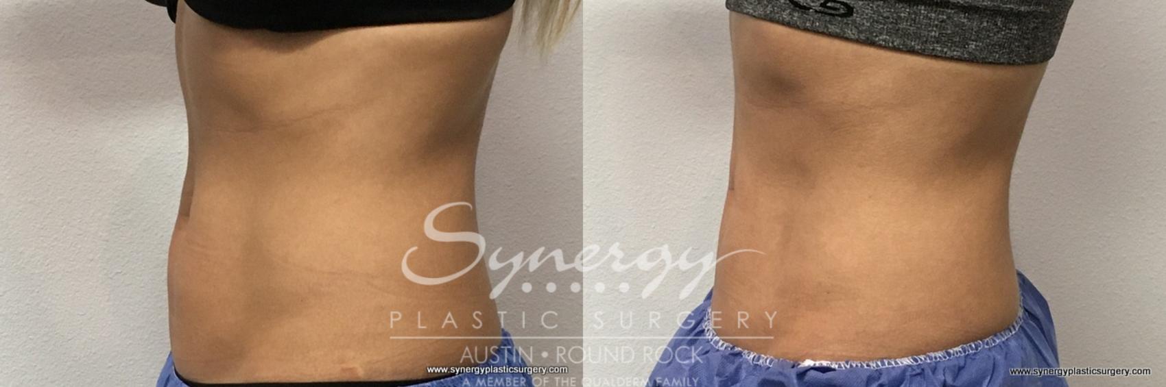 Before & After CoolSculpting® Case 762 View #3 View in Round Rock, TX
