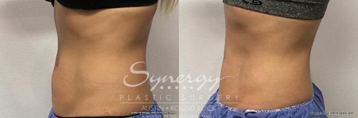Before & After CoolSculpting® Case 762 View #3 View in Austin, TX