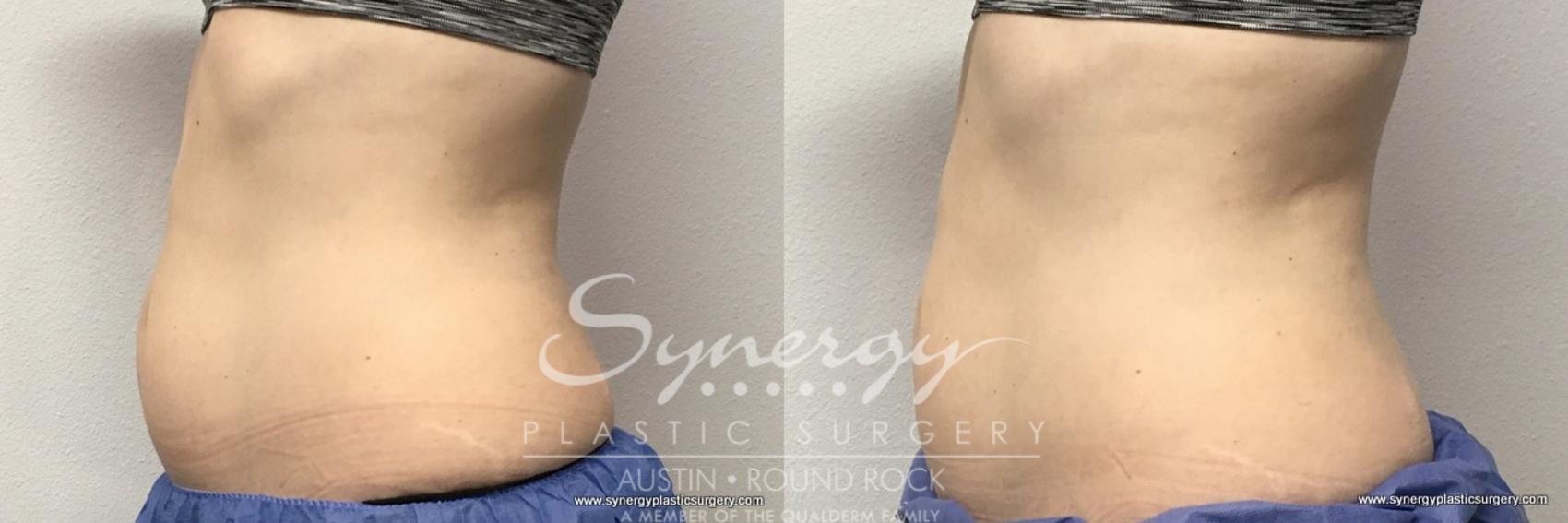 Before & After CoolSculpting® Case 763 View #1 View in Round Rock, TX