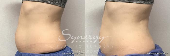 Before & After CoolSculpting® Case 763 View #1 View in Austin, TX