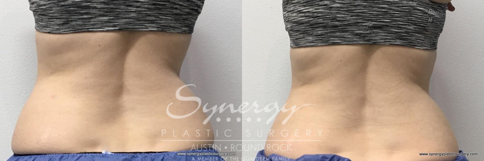 Before & After CoolSculpting® Case 763 View #2 View in Round Rock, TX