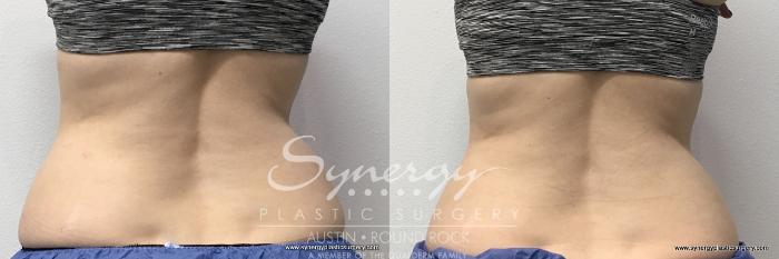 Before & After CoolSculpting® Case 763 View #2 View in Austin, TX
