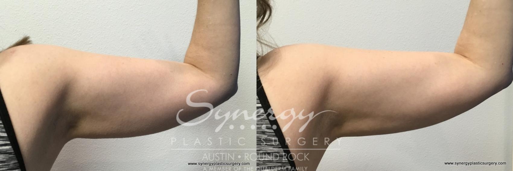 Before & After CoolSculpting® Case 763 View #3 View in Round Rock, TX