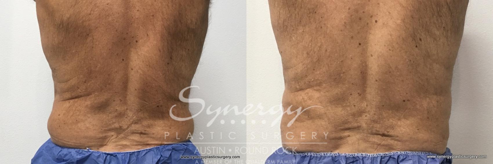 Before & After CoolSculpting® Case 764 View #1 View in Austin, TX