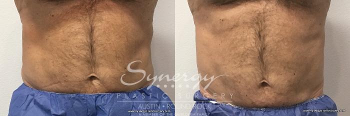 Before & After CoolSculpting® Case 764 View #2 View in Austin, TX