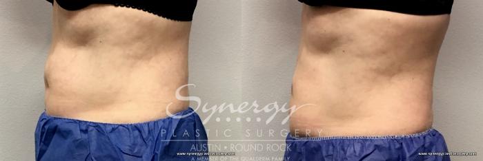 Before & After CoolSculpting® Case 765 View #1 View in Austin, TX
