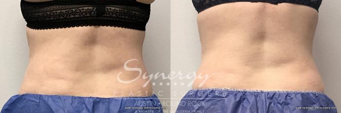 Before & After CoolSculpting® Case 765 View #2 View in Austin, TX