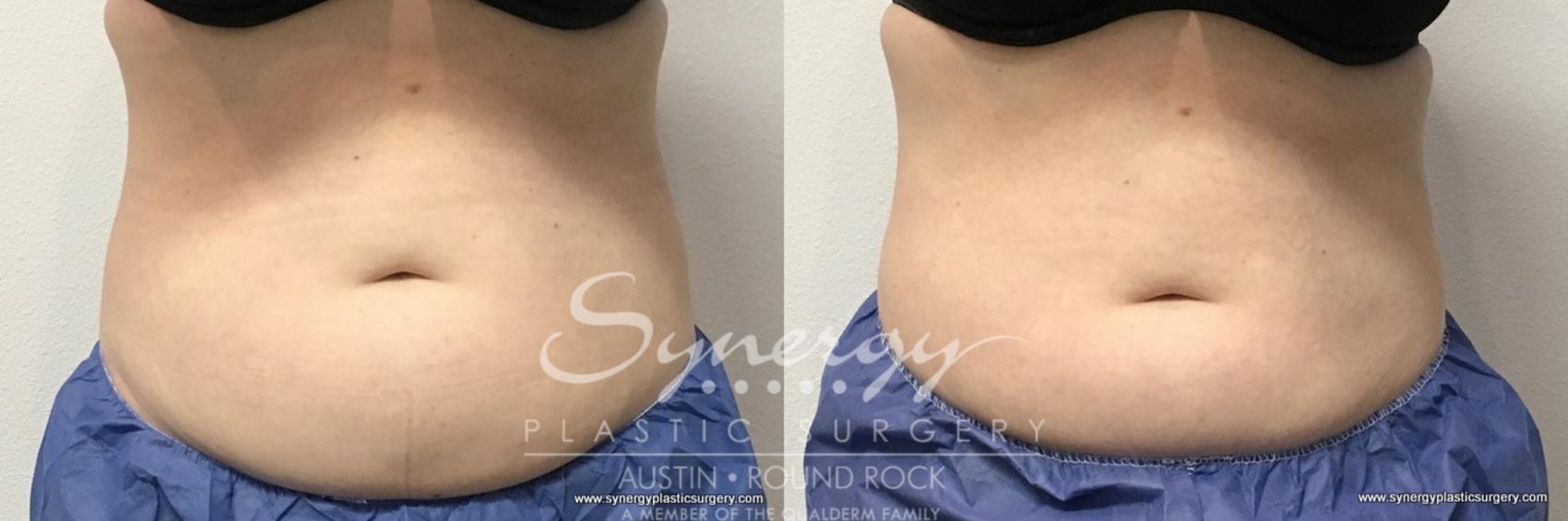 Before & After CoolSculpting® Case 766 View #1 View in Round Rock, TX