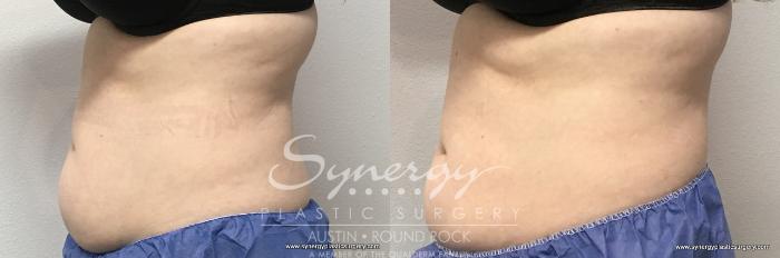 Before & After CoolSculpting® Case 766 View #2 View in Austin, TX