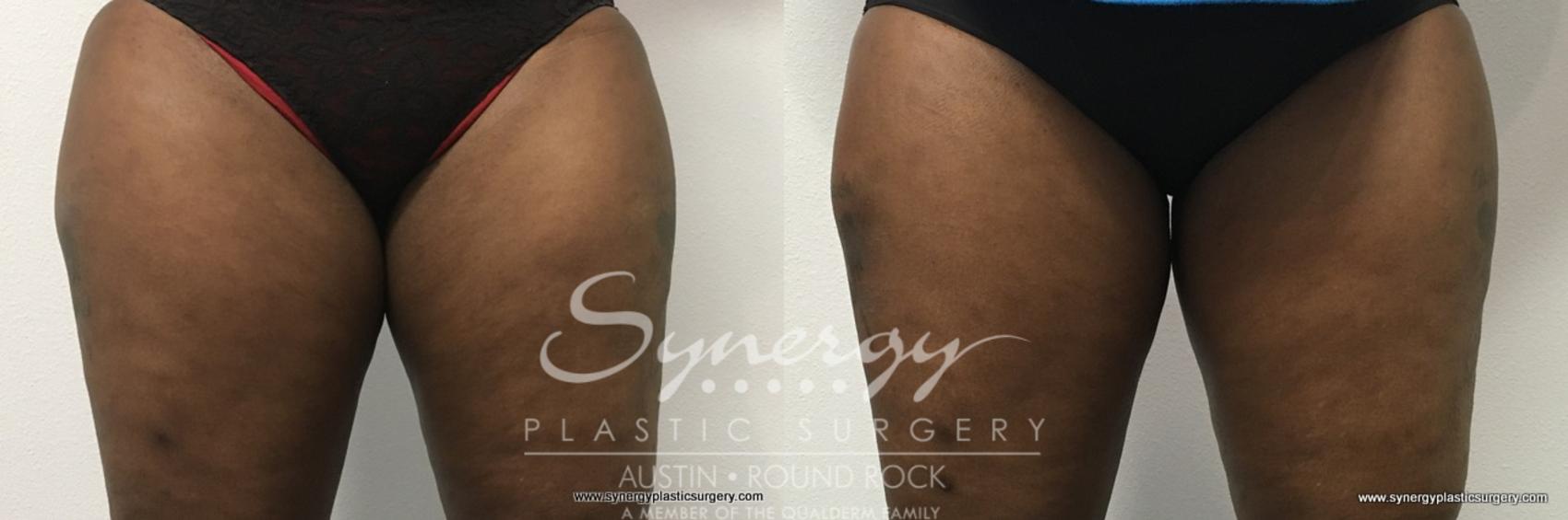 Before & After CoolSculpting® Case 767 View #1 View in Round Rock, TX