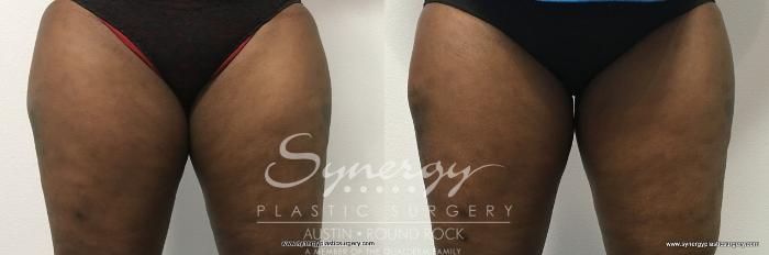 Before & After CoolSculpting® Case 767 View #1 View in Austin, TX