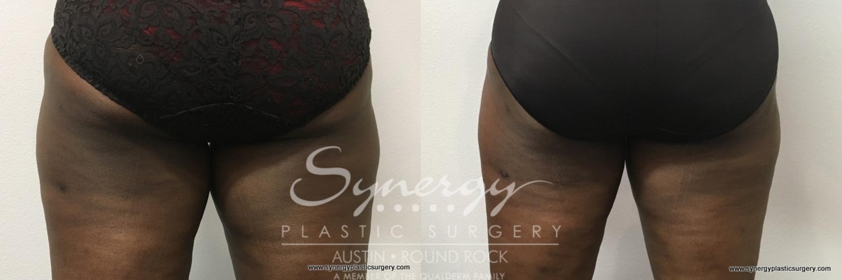 Before & After CoolSculpting® Case 767 View #2 View in Round Rock, TX