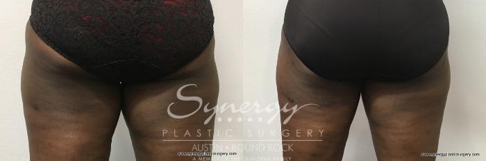 Before & After CoolSculpting® Case 767 View #2 View in Austin, TX
