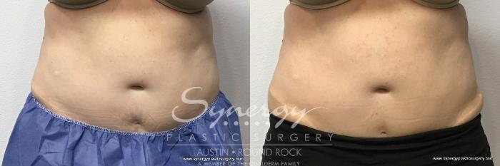 CoolSculpting Before and After Pictures - Female Stomach