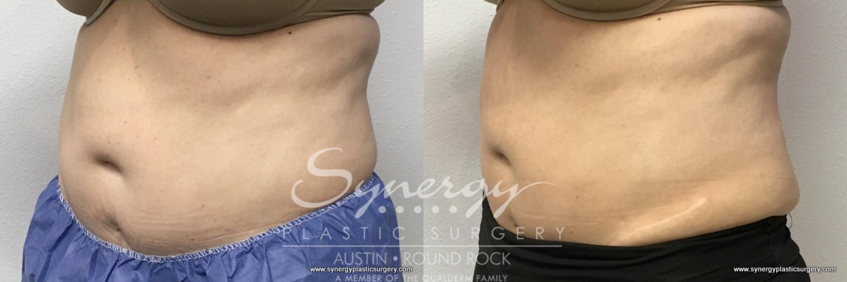 Before & After CoolSculpting® Case 768 View #2 View in Round Rock, TX