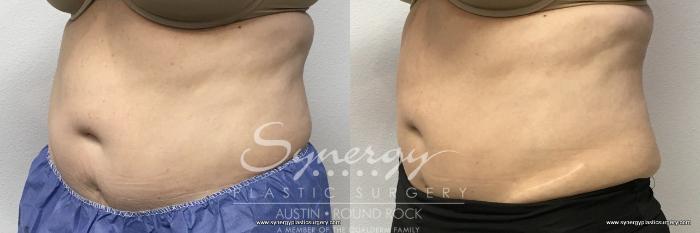 Before & After CoolSculpting® Case 768 View #2 View in Austin, TX
