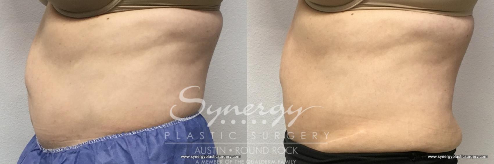 Before & After CoolSculpting® Case 768 View #3 View in Round Rock, TX