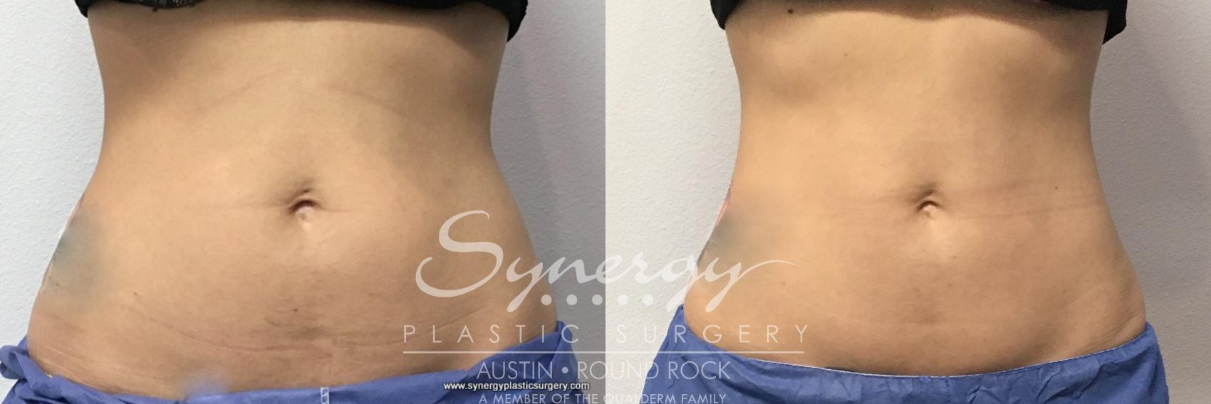 Before & After CoolSculpting® Case 769 View #1 View in Round Rock, TX