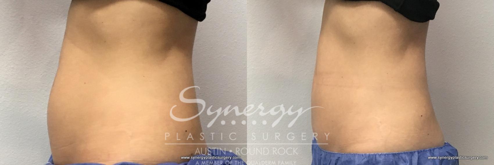 Before & After CoolSculpting® Case 769 View #2 View in Round Rock, TX