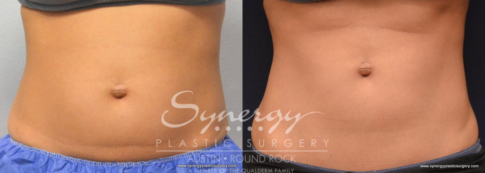 Before & After CoolSculpting® Case 770 View #1 View in Round Rock, TX