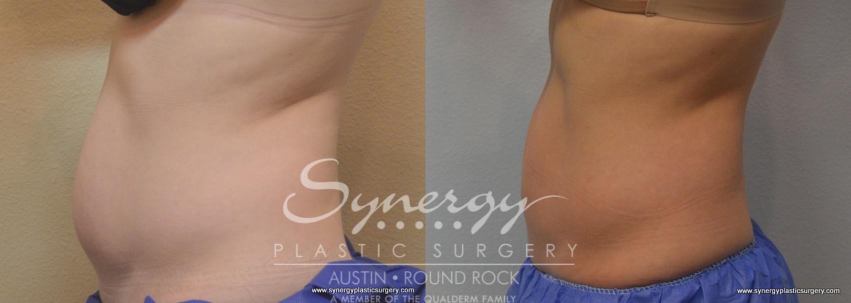 Before & After CoolSculpting® Case 771 View #1 View in Round Rock, TX