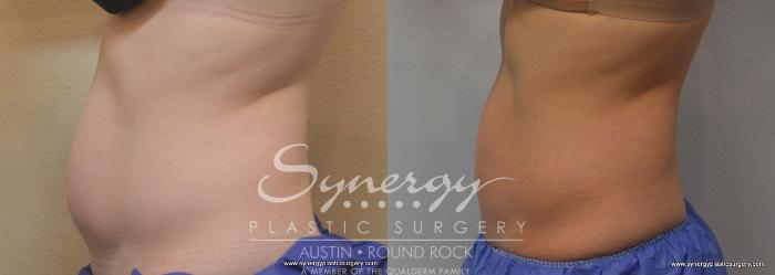 Before & After CoolSculpting® Case 771 View #1 View in Austin, TX