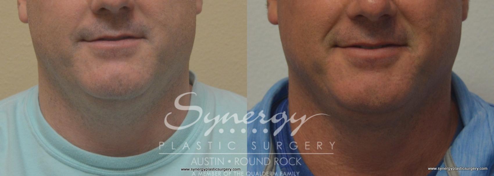 Before & After CoolSculpting® Case 772 View #1 View in Round Rock, TX