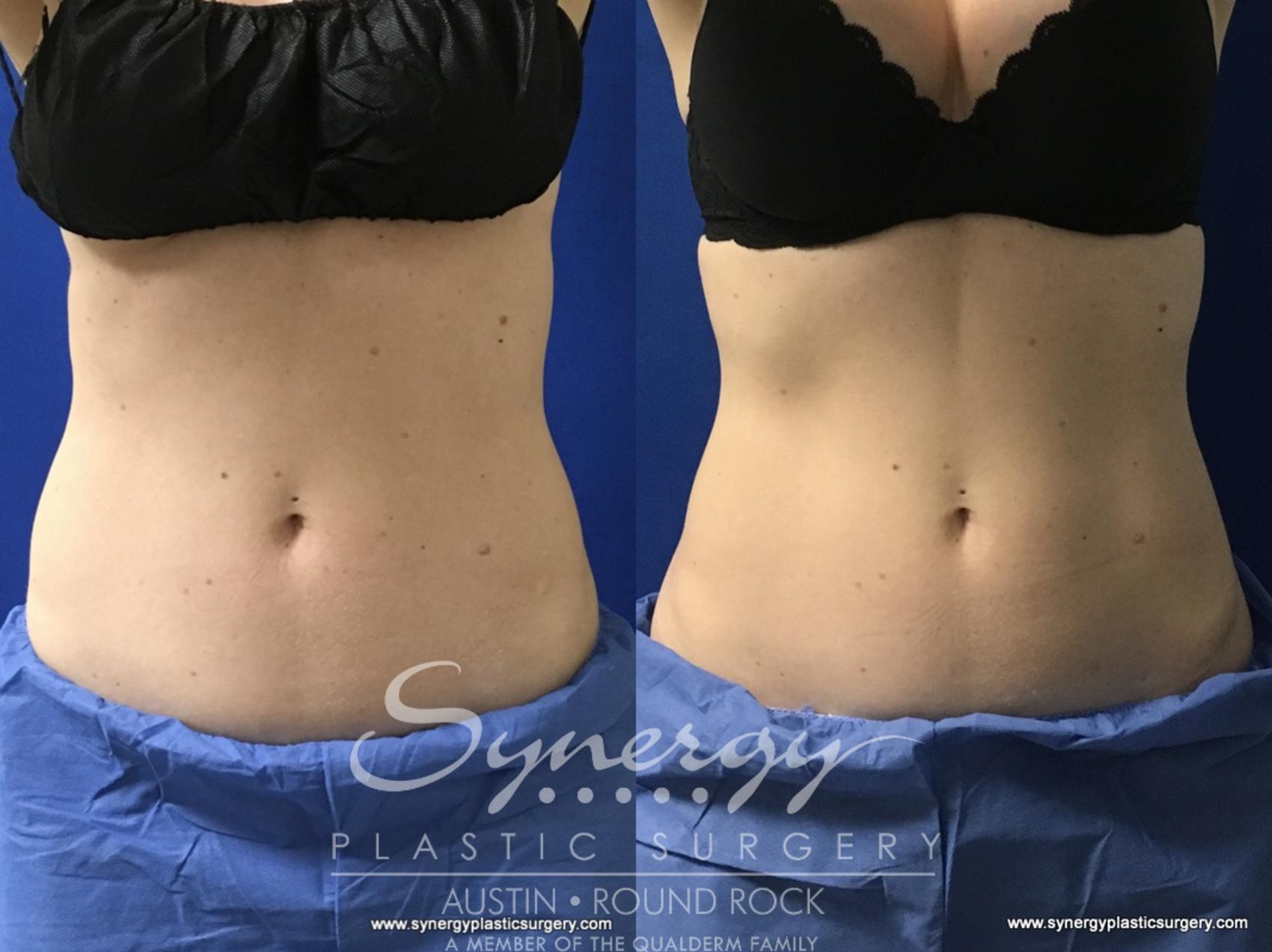 Before & After CoolSculpting® Case 773 View #1 View in Round Rock, TX