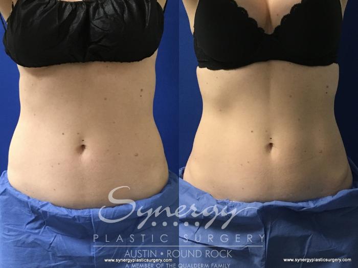 Before & After CoolSculpting® Case 773 View #1 View in Austin, TX