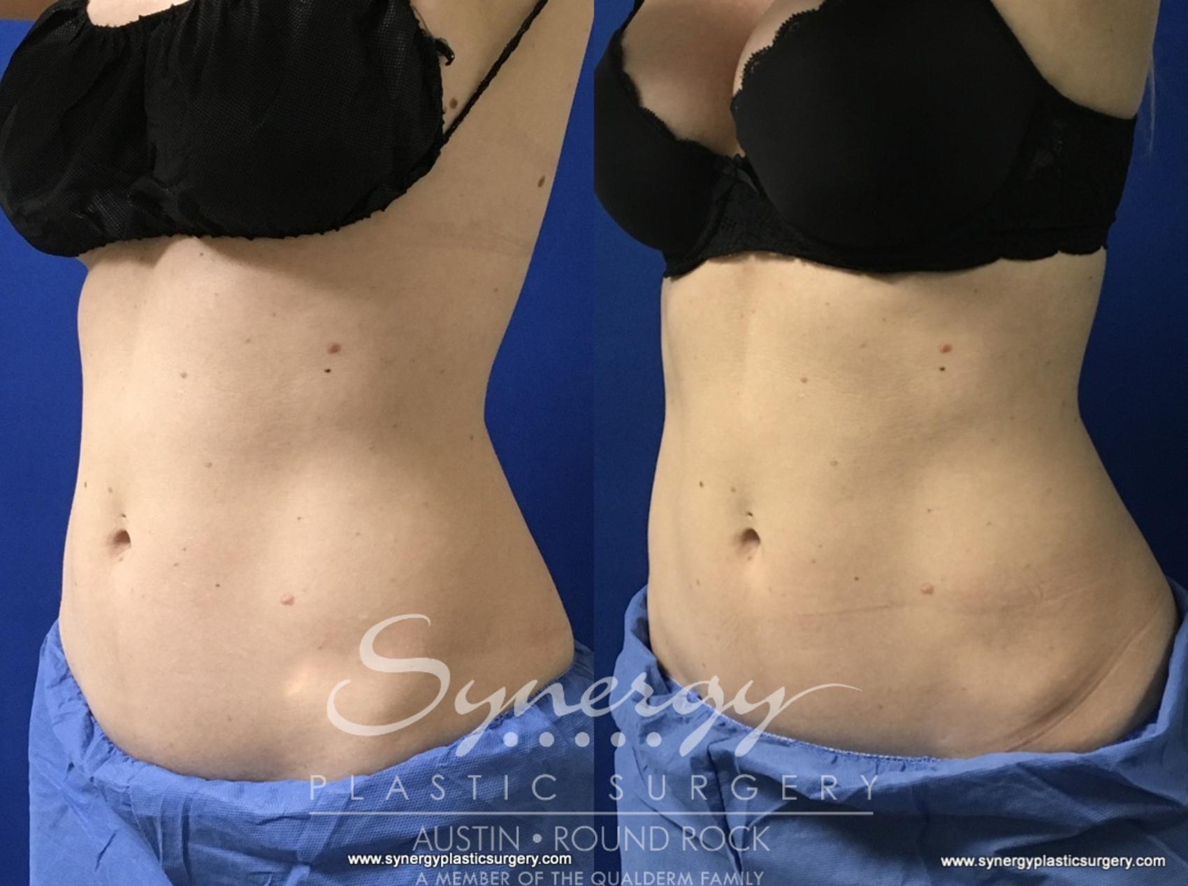Before & After CoolSculpting® Case 774 View #1 View in Austin, TX