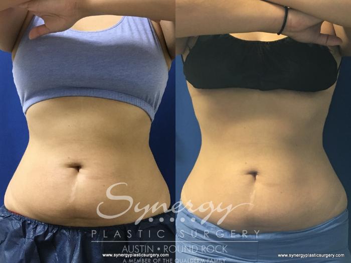 Before & After CoolSculpting® Case 775 View #1 View in Austin, TX