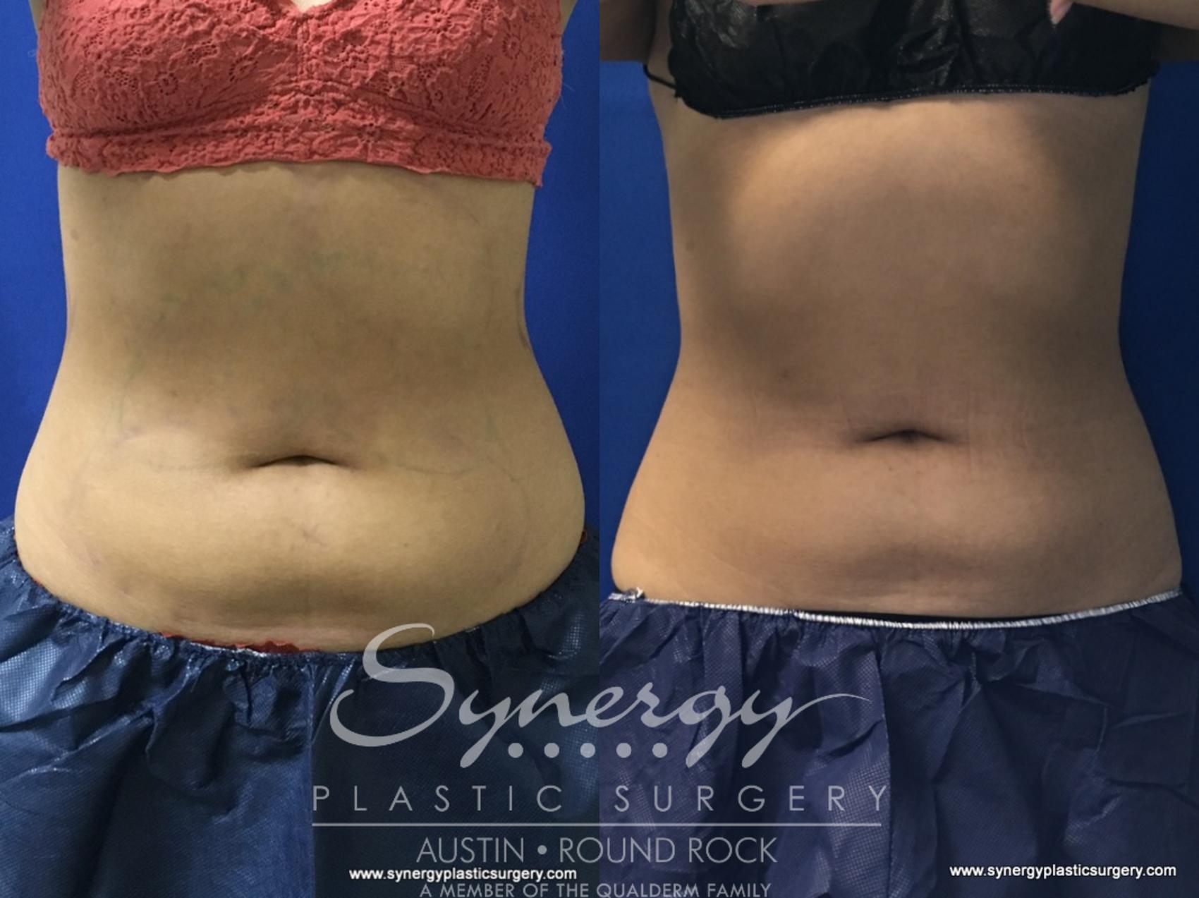 Before & After CoolSculpting® Case 777 View #1 View in Round Rock, TX