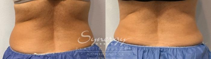 Before & After CoolSculpting® Case 854 Back View in Austin, TX