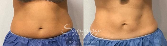 Before & After CoolSculpting® Case 854 Front View in Austin, TX