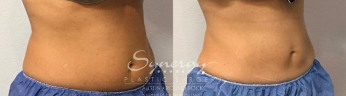 Before & After CoolSculpting® Case 854 Left Oblique View in Austin, TX