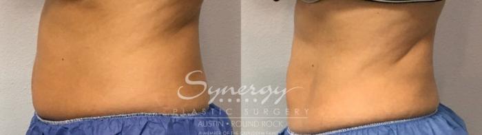 Before & After CoolSculpting® Case 854 Right Side View in Austin, TX