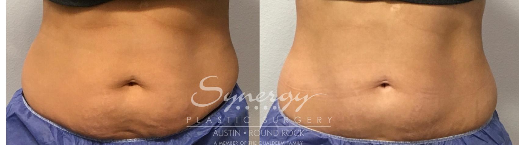 Before & After CoolSculpting® Case 856 Front View in Austin, TX